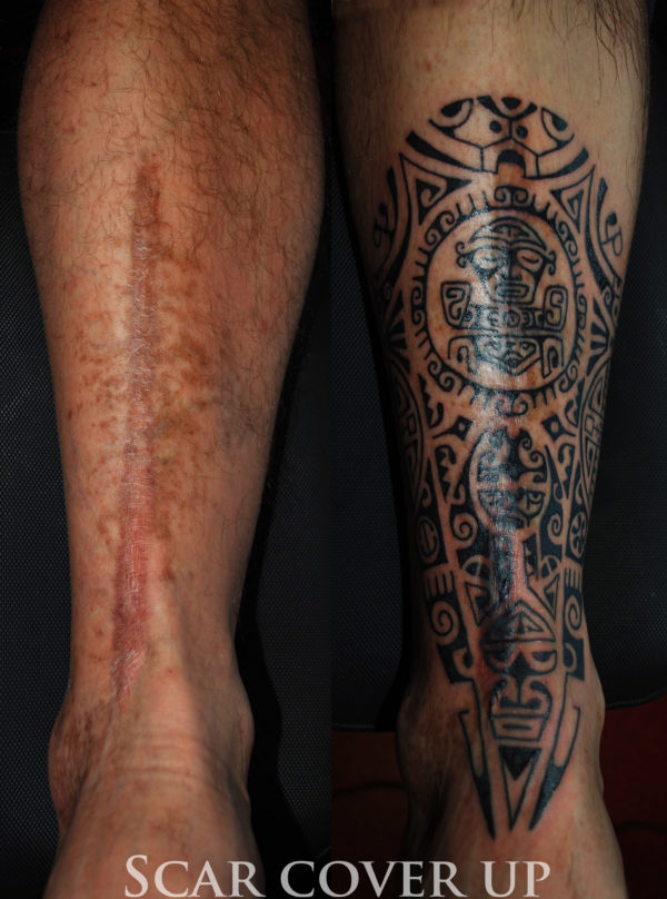 Copertura di una cicatrice con un tatuaggio marchesano