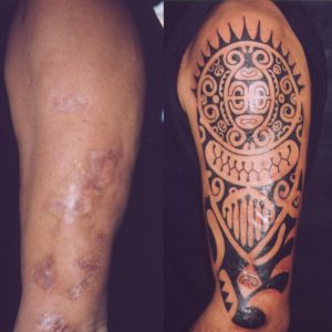 Copertura di bruciatura con un tatuaggio polinesiano